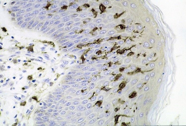 Epidermiste çok sayıda dendritik (Langerhans) hücre gösteren deri bölümü. M. ulcerans enfeksiyonu, S100 immünoperoksidaz boyası.