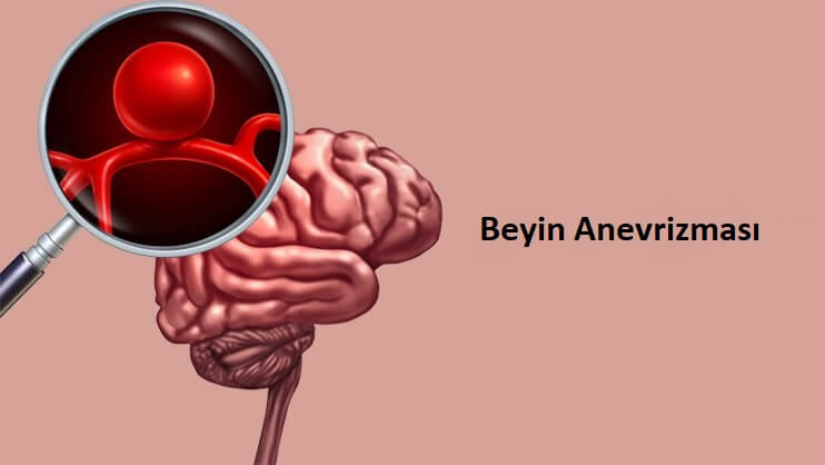 beyin anevrizmasi