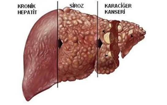 Karaciğer Hastalıkları