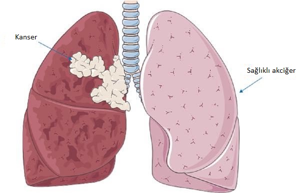 Akciğer Kanseri