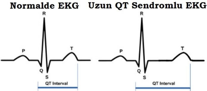 Uzun QT Sendromu