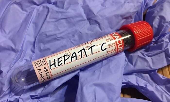 hepatit c 