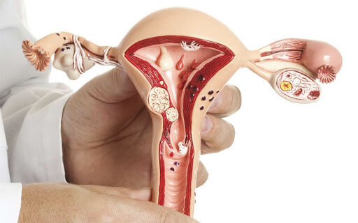 Endometrial Ablasyon