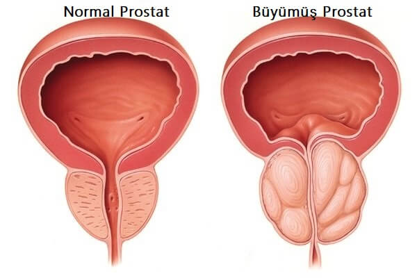 Prostat Büyümesi