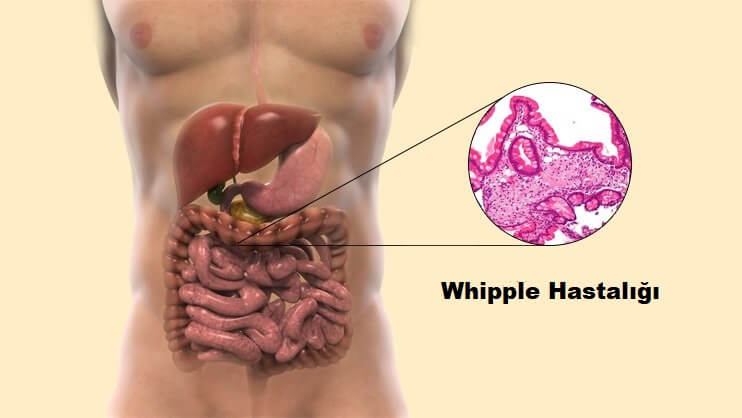 Whipple Hastalığı