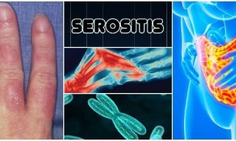 Serositis