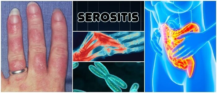 Serositis