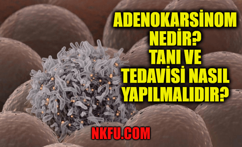 Adenokarsinom Nedir? Tanımı, Kanser Çeşitleri, Tanı ve Tedavisi